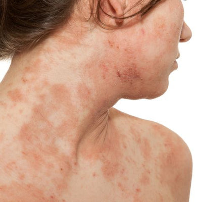 Skin Irritations, 3 Effective Ways to Treat Them!