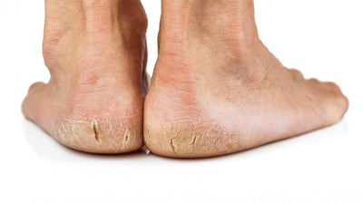 How to Heal Cracked Heels