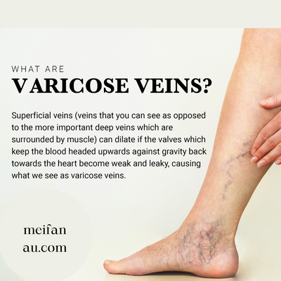 Varicose Veins - Will You get It?