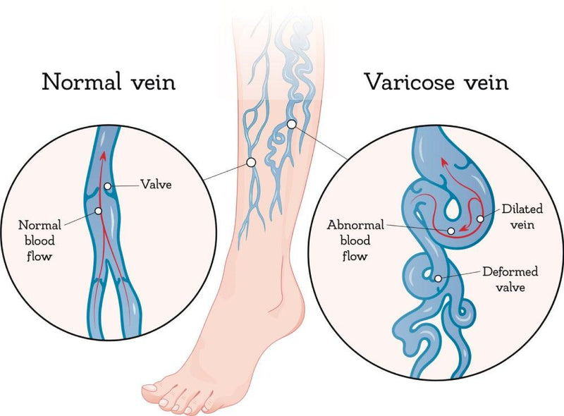 caruso_sVARICOSE-VEIN.jpg